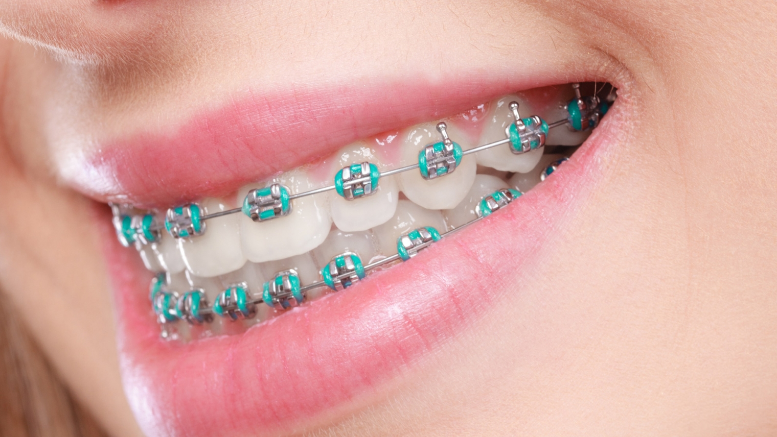Metal braces – Im Orthodontics